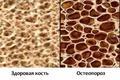 Клеточная терапия обращает возрастной остеопороз у мышей